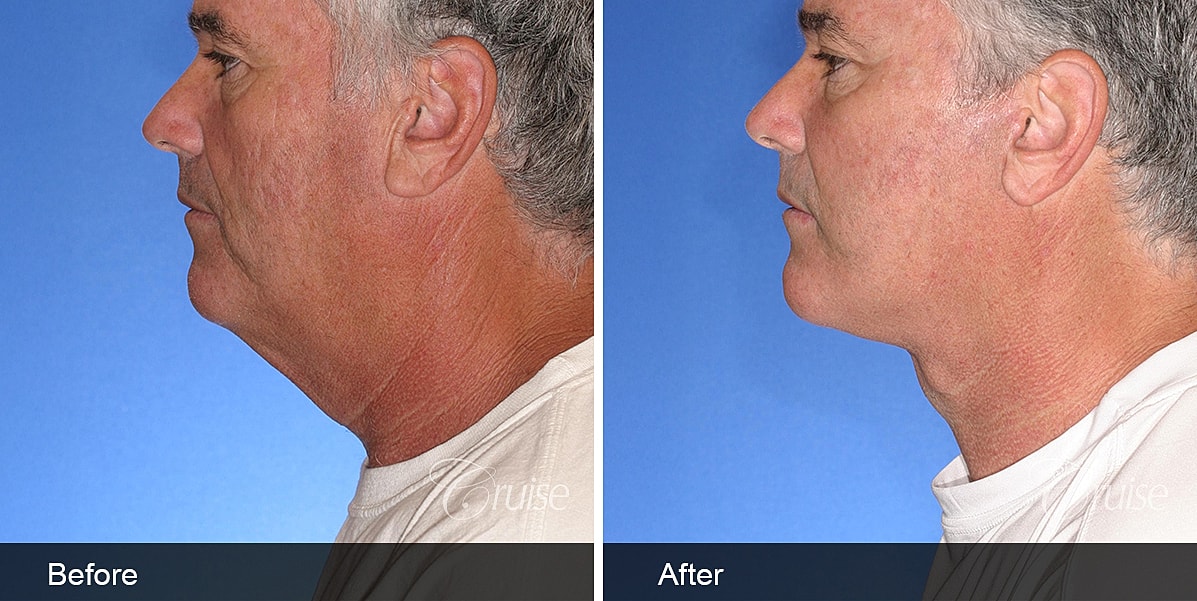 Neck Lift Before & After
