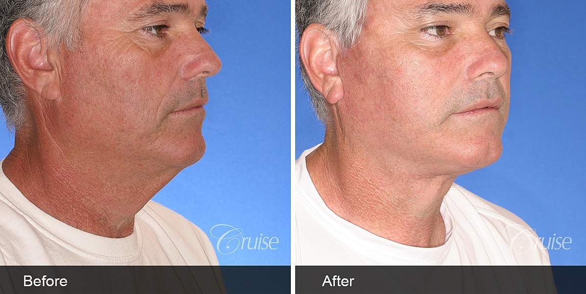 Neck Lift Before & After