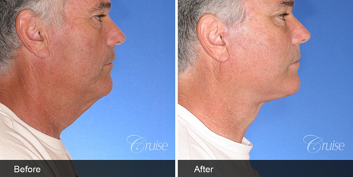 Neck Lift Before & After