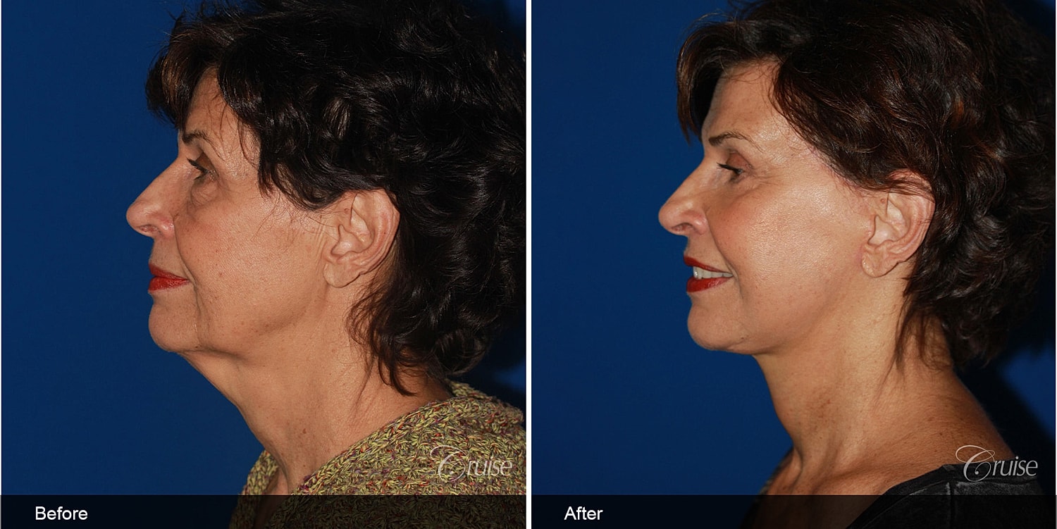 Neck Lift Before & After