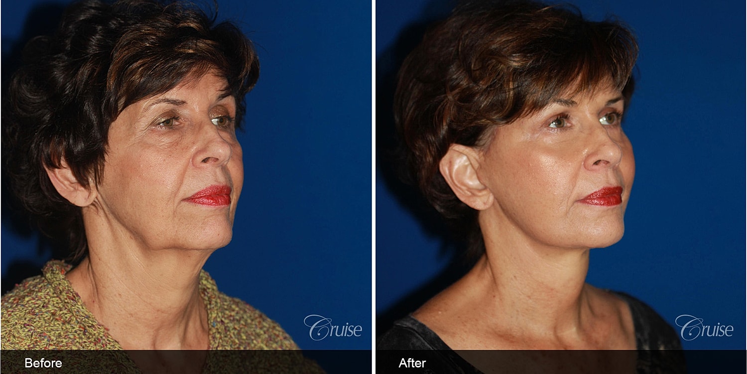 Neck Lift Before & After