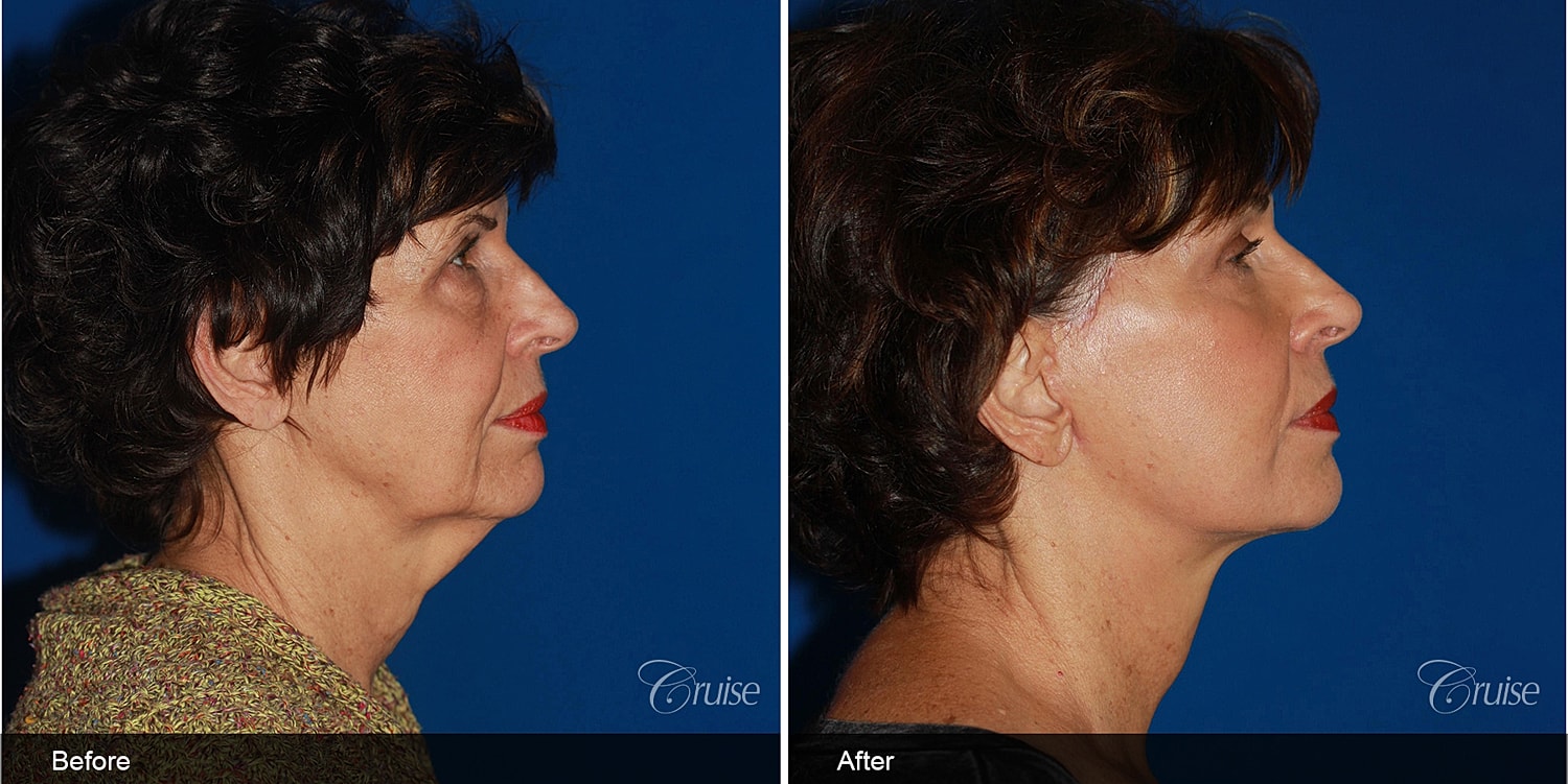 Neck Lift Before & After