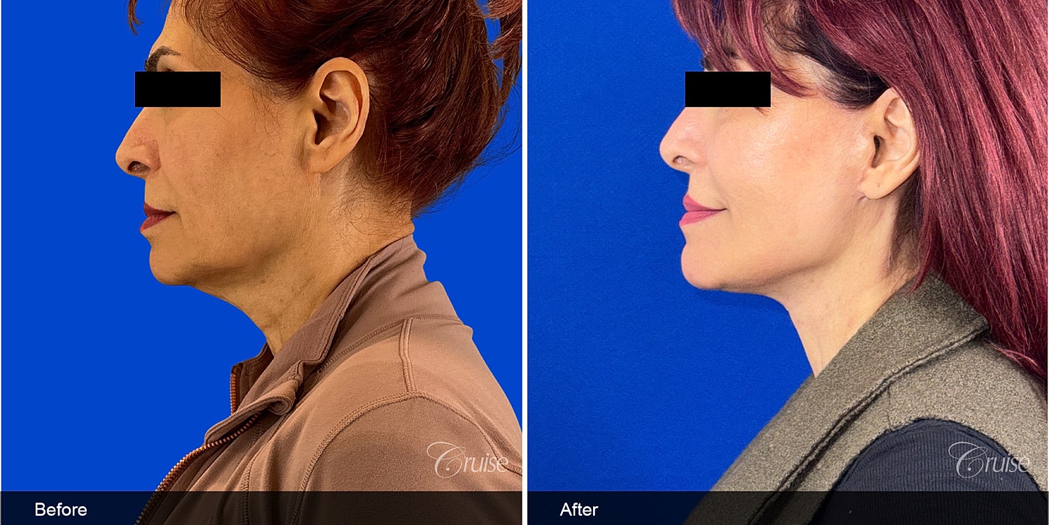 Neck Lift Before & After