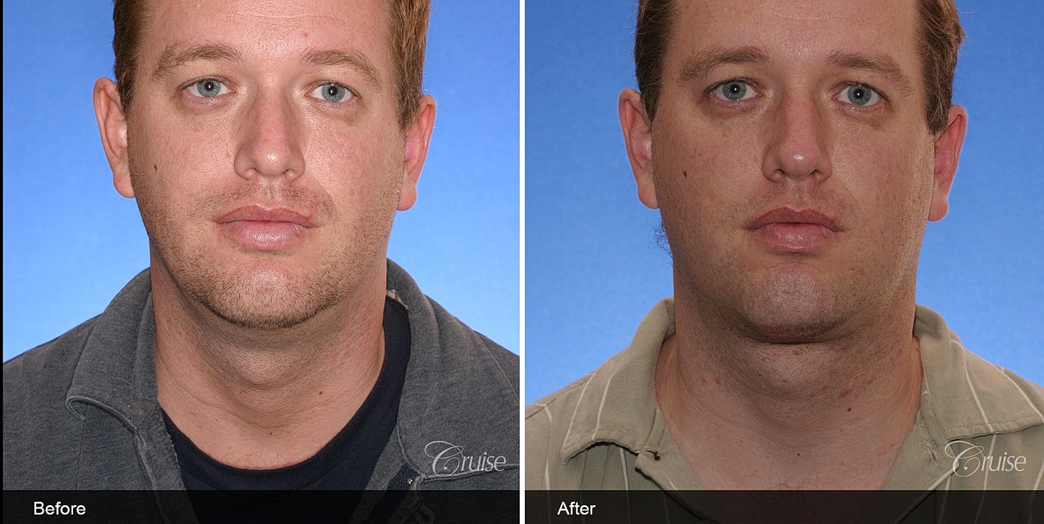Neck Lift Before & After