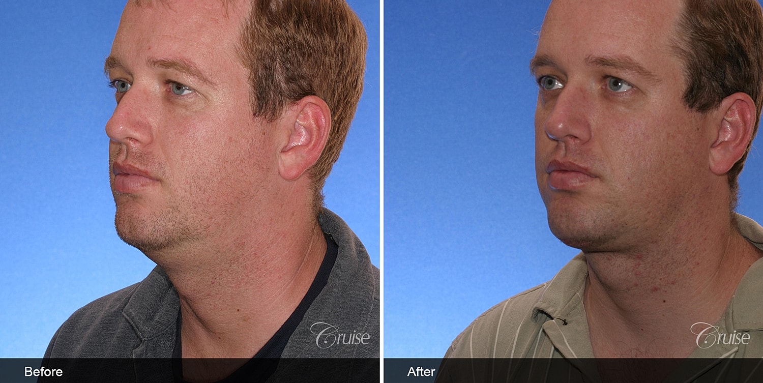 Neck Lift Before & After