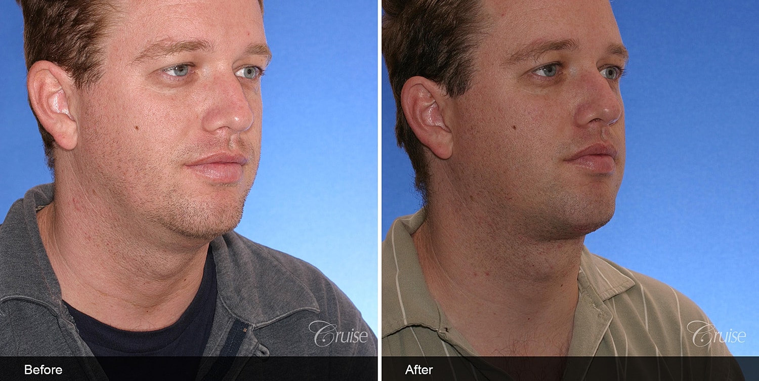 Neck Lift Before & After