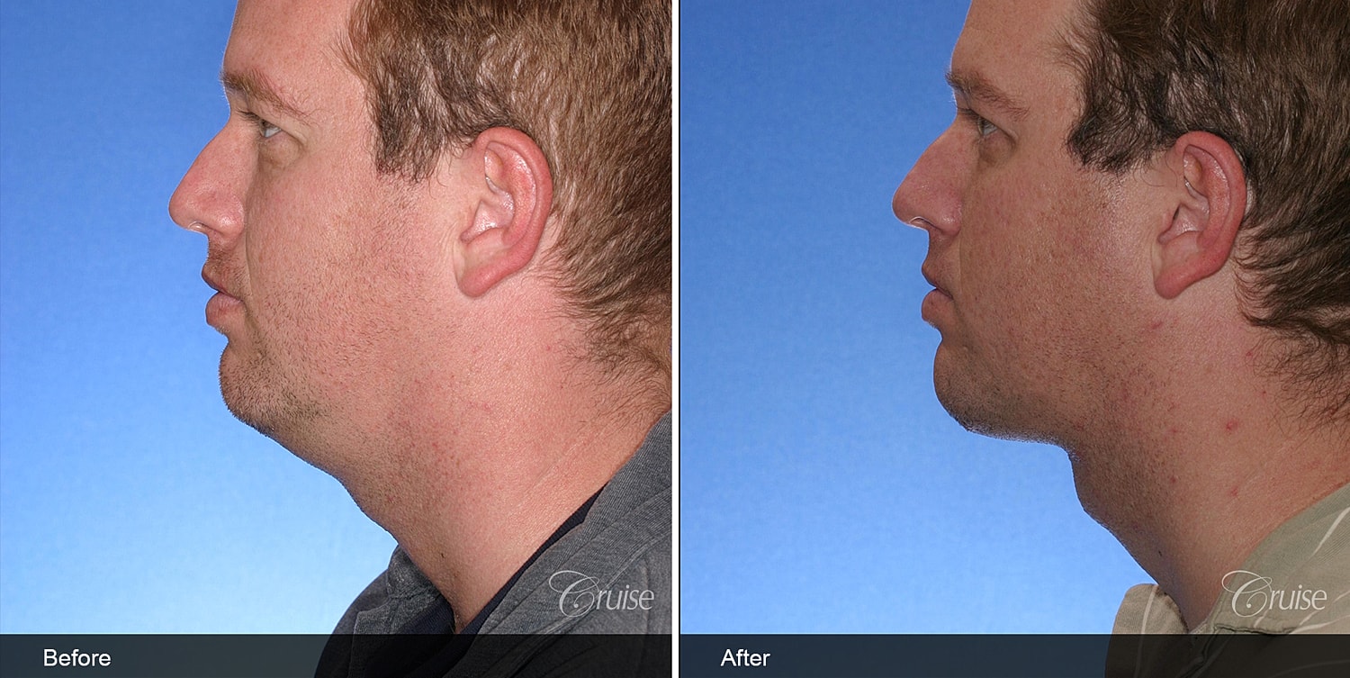 Neck Lift Before & After