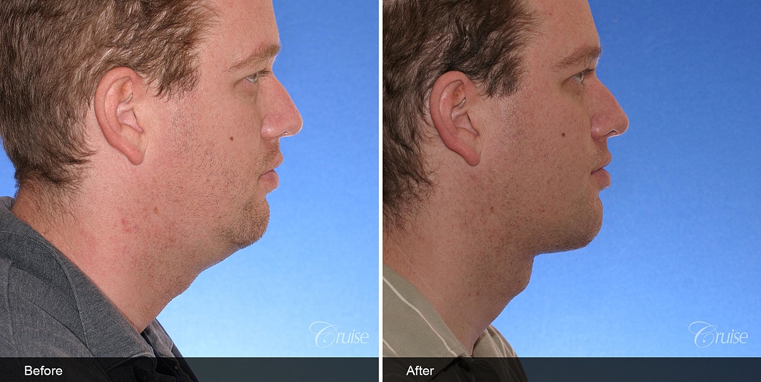 Neck Lift Before & After