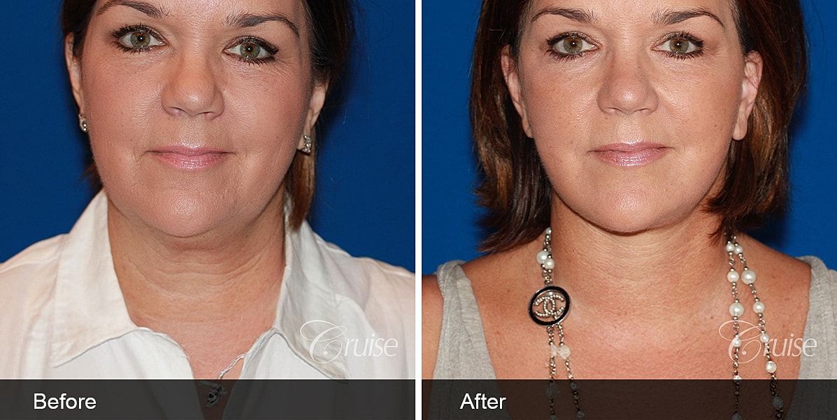 Neck Lift Before & After