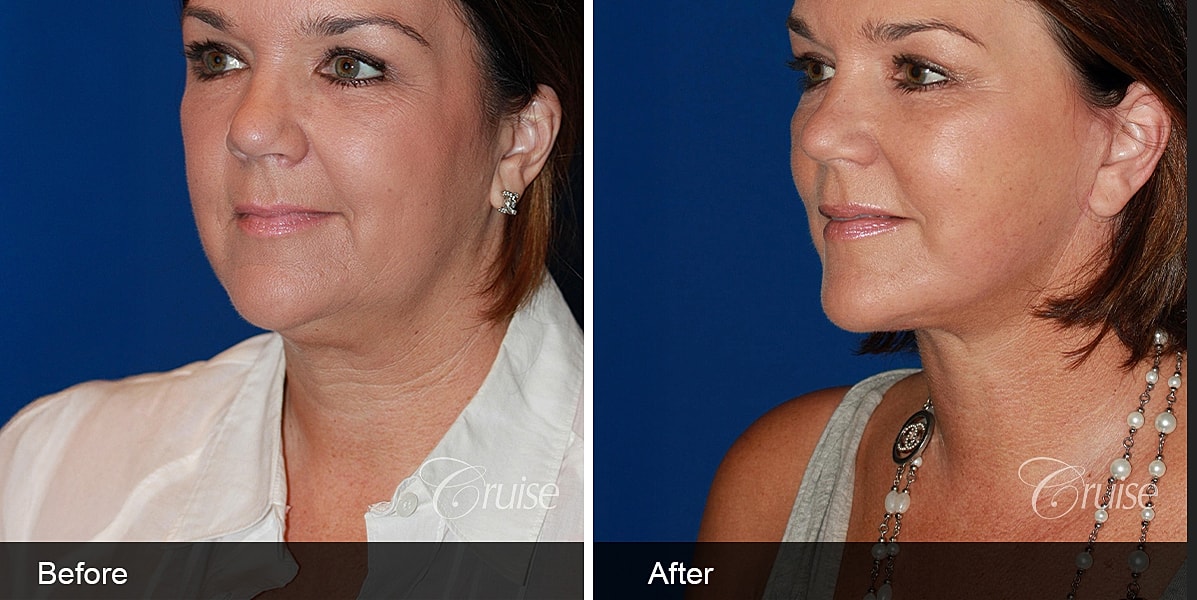 Neck Lift Before & After
