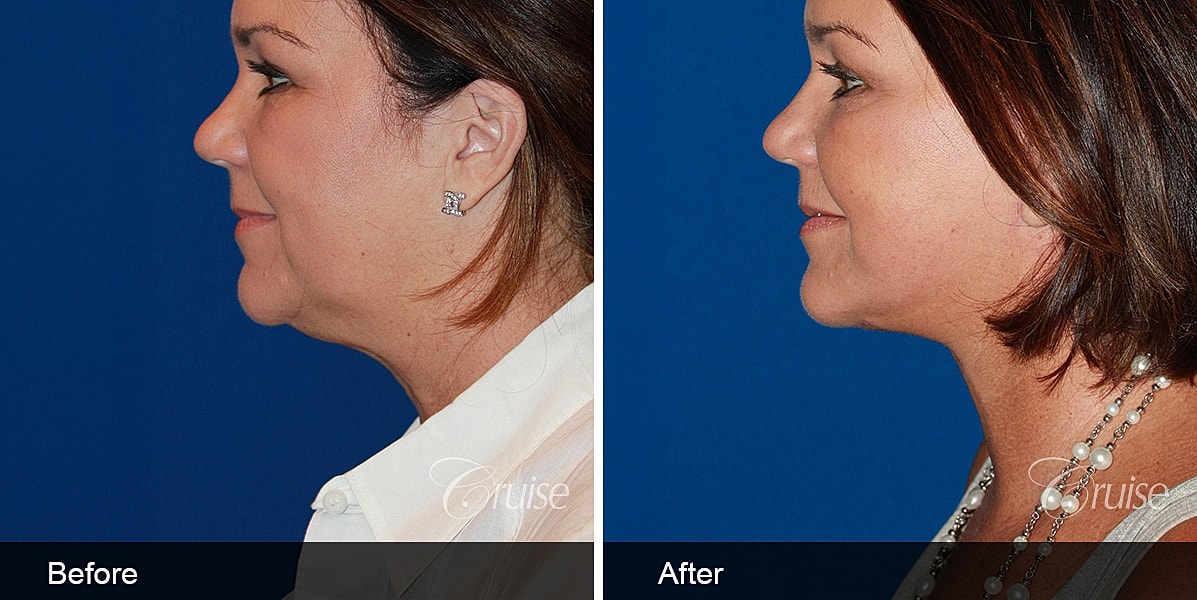 Neck Lift Before & After