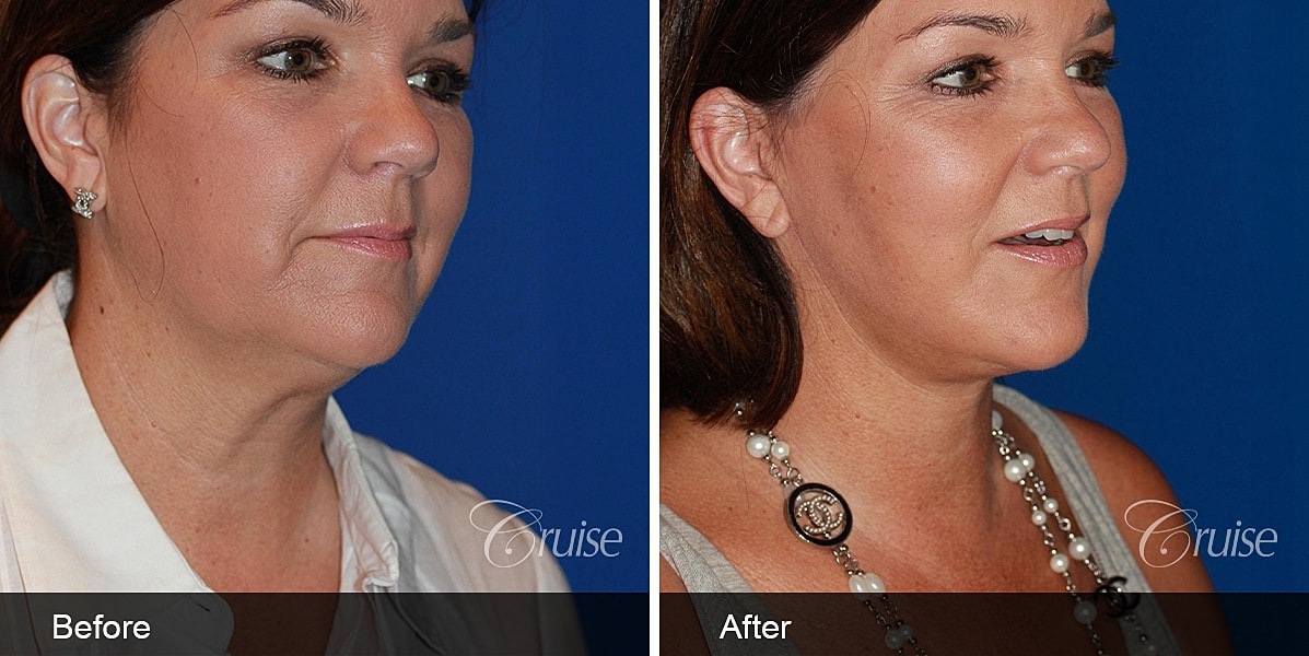 Neck Lift Before & After
