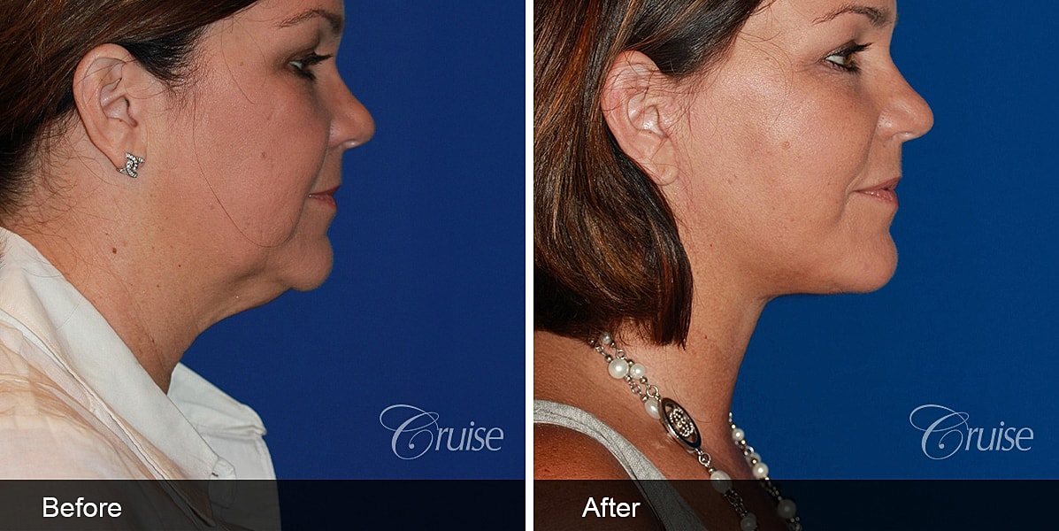 Neck Lift Before & After