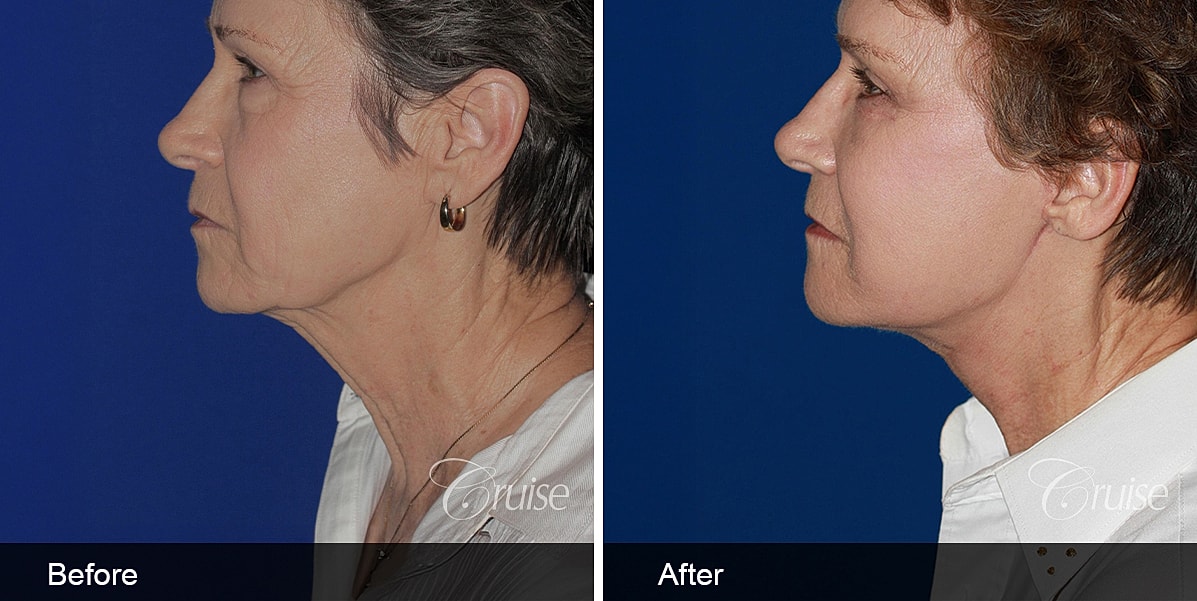 Neck Lift Before & After