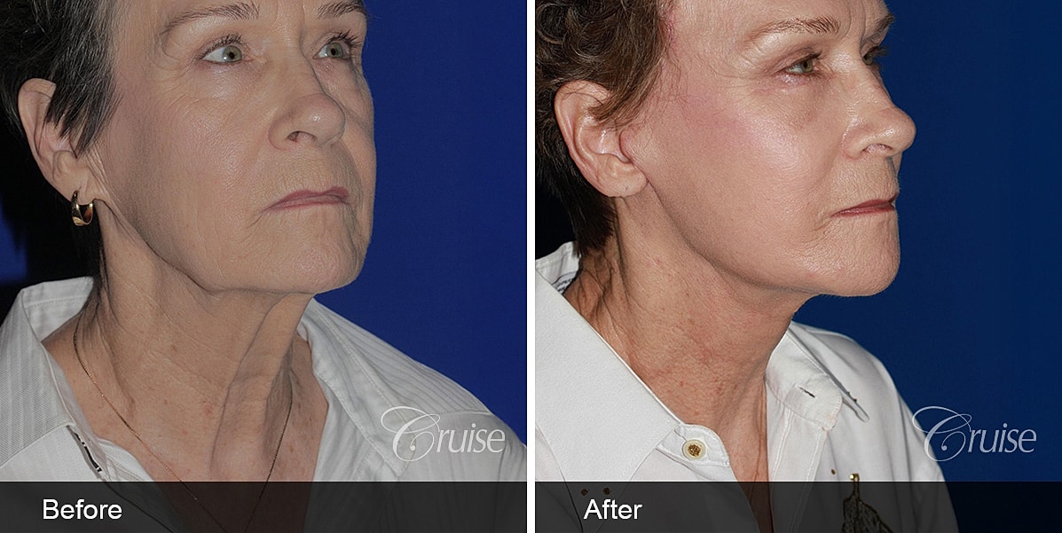 Neck Lift Before & After