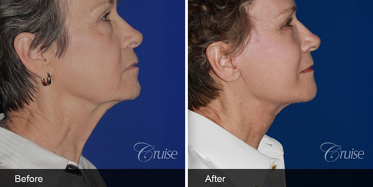 Neck Lift Before & After