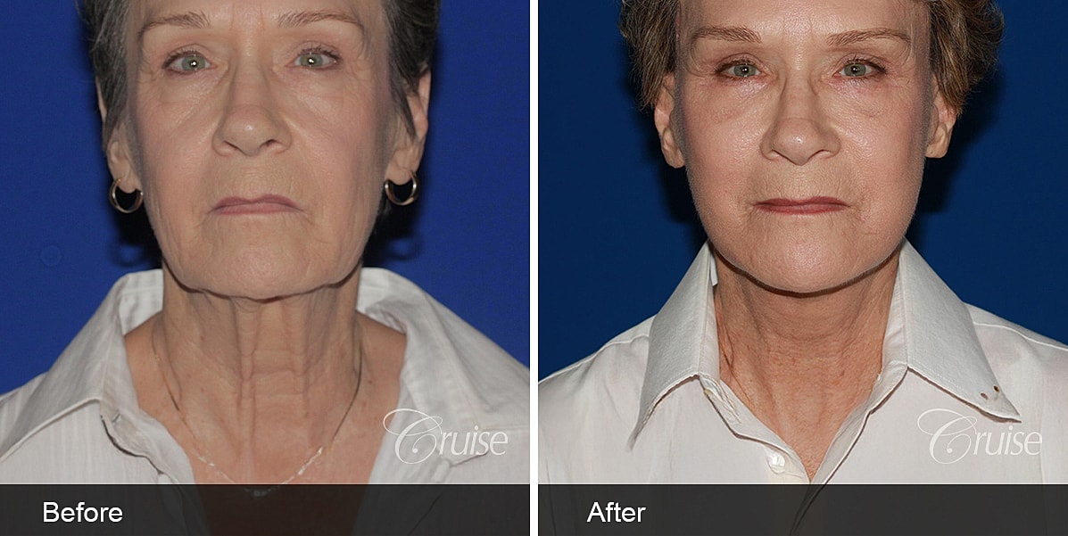 Neck Lift Before & After