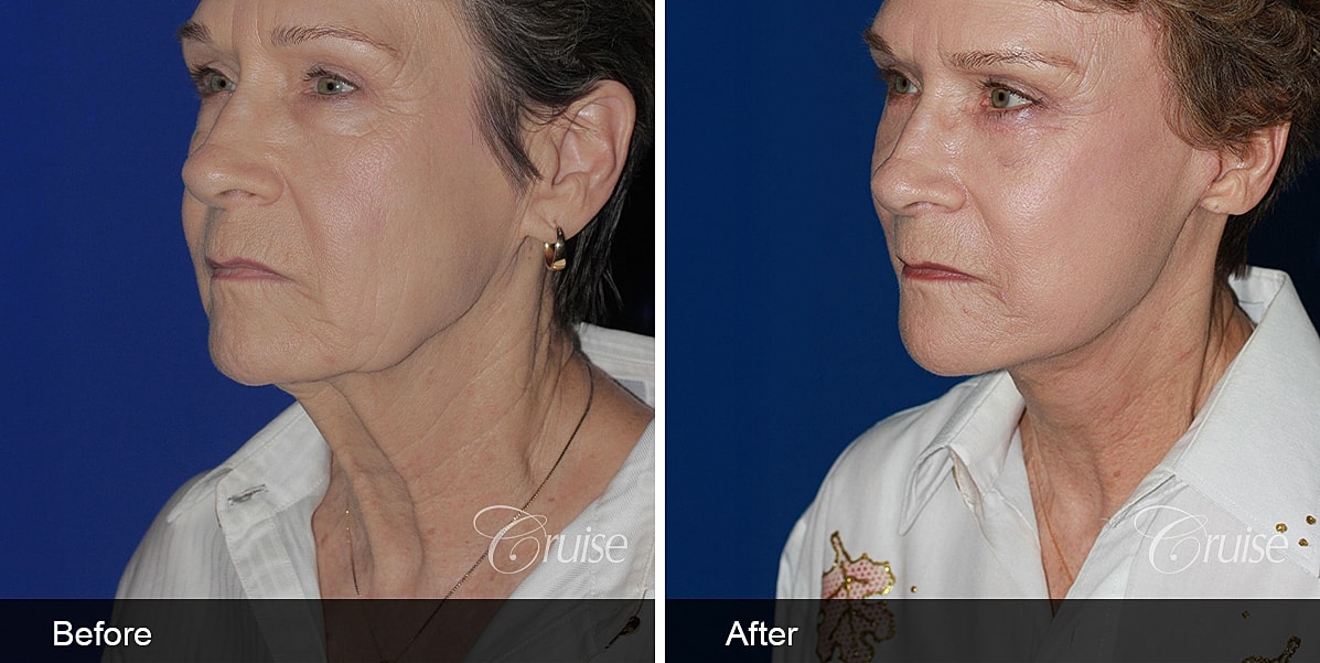 Neck Lift Before & After