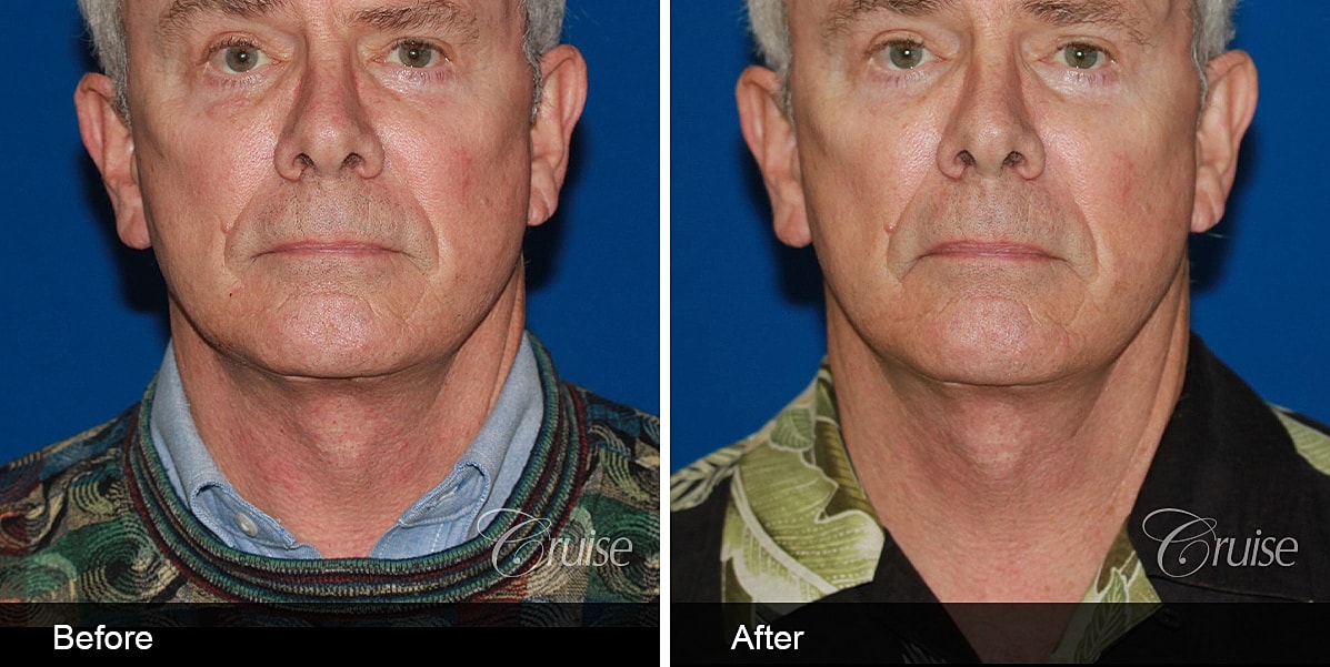 Neck Lift Before & After