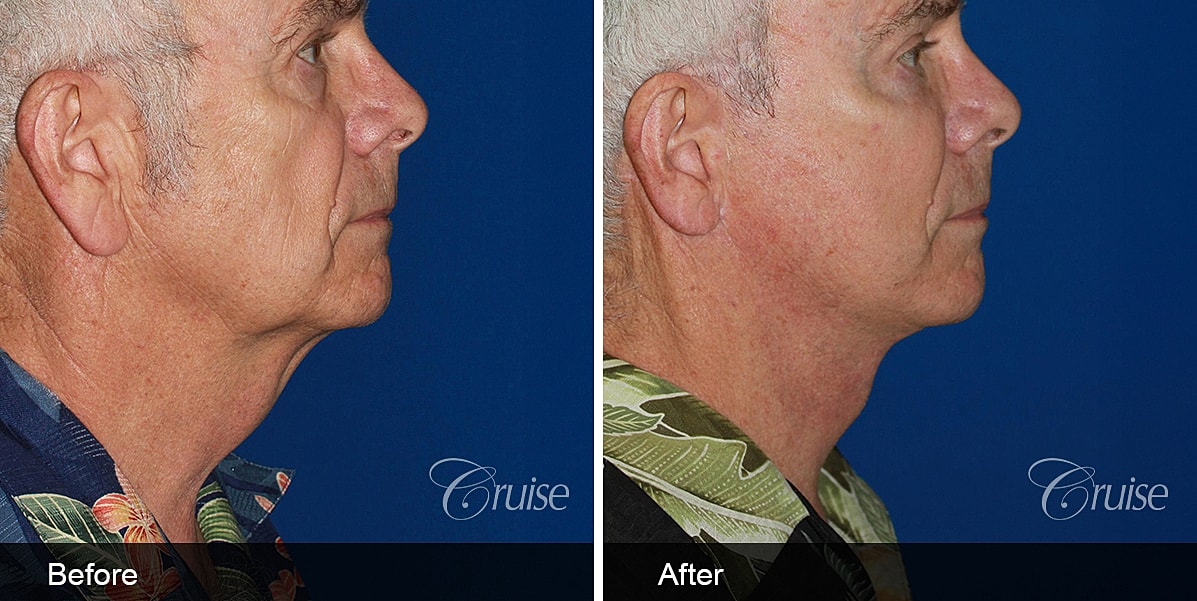 Neck Lift Before & After