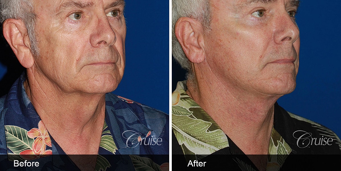 Neck Lift Before & After