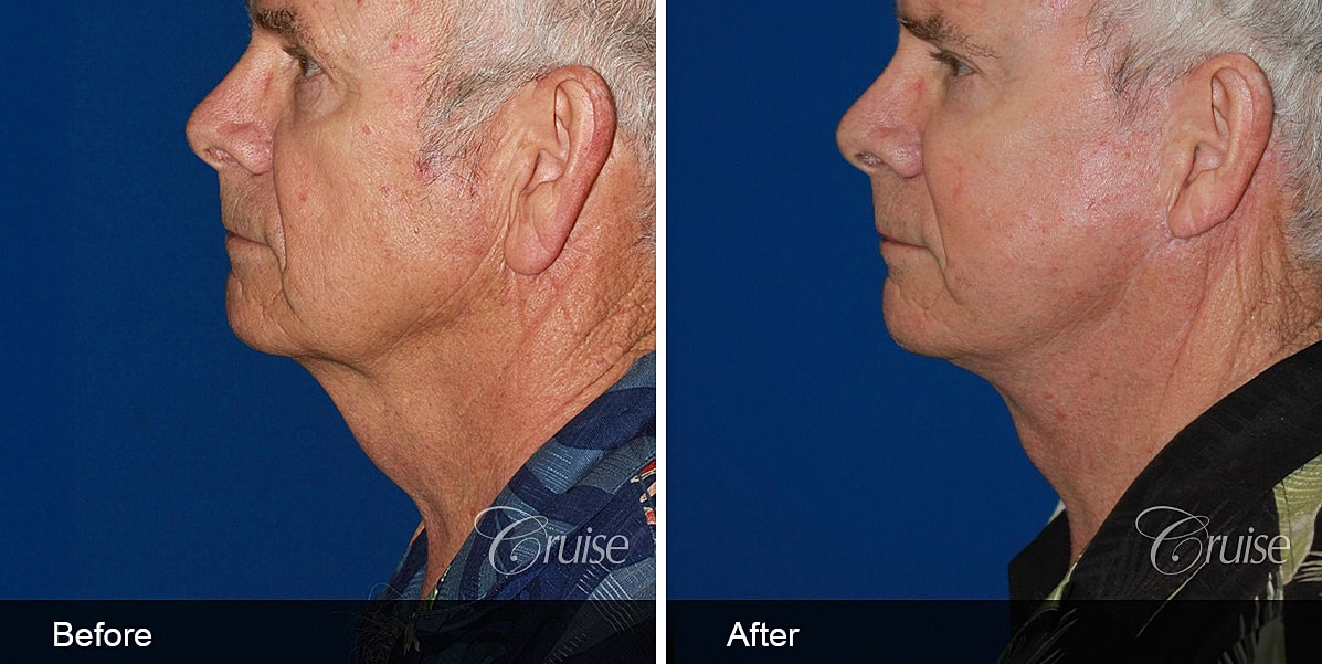 Neck Lift Before & After