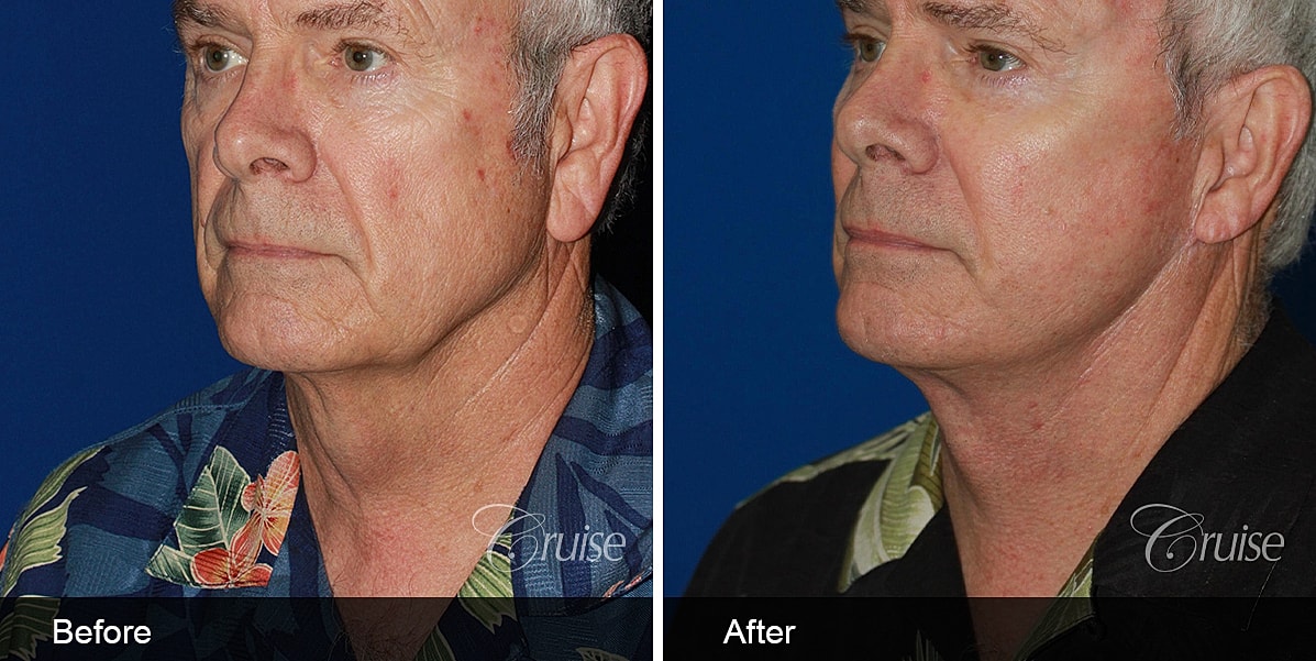Neck Lift Before & After