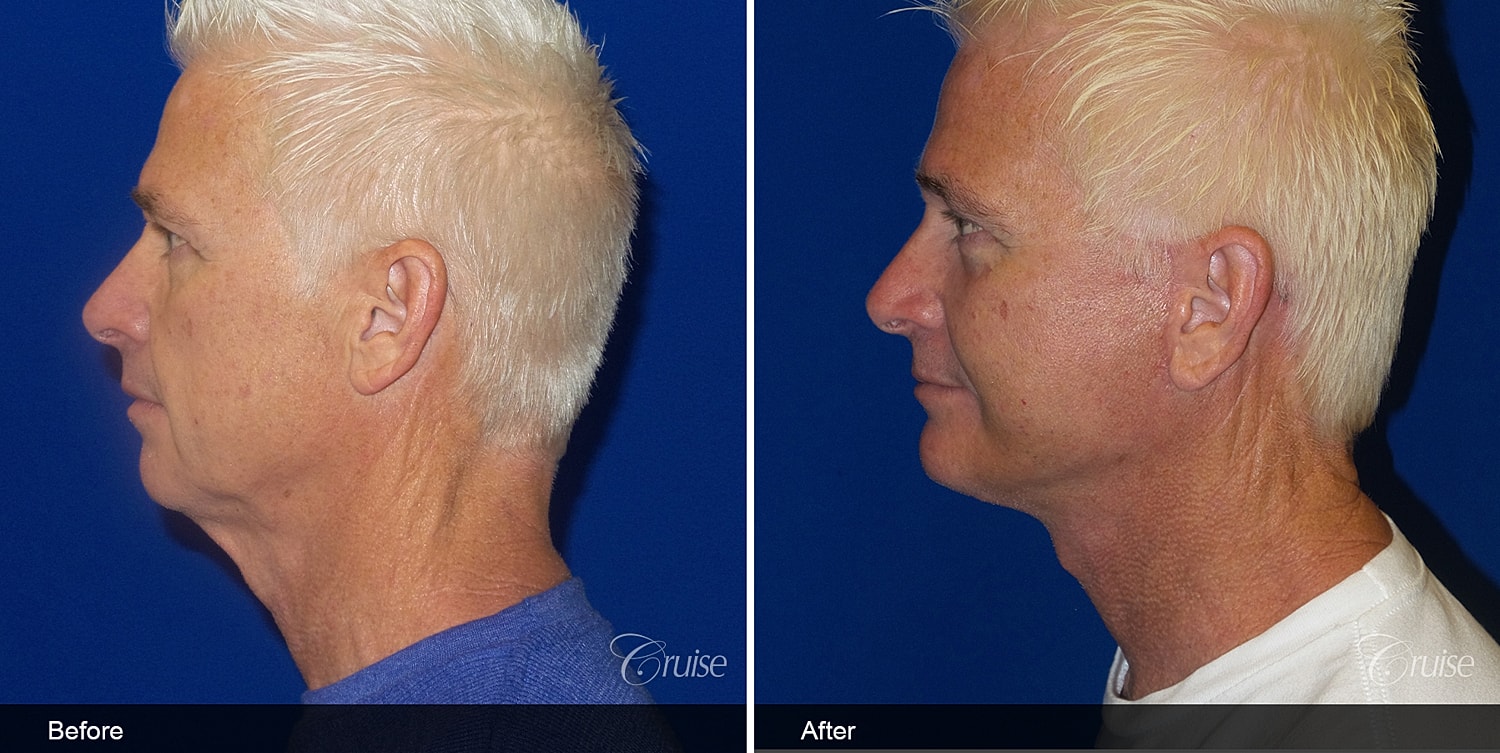 Neck Lift Before & After