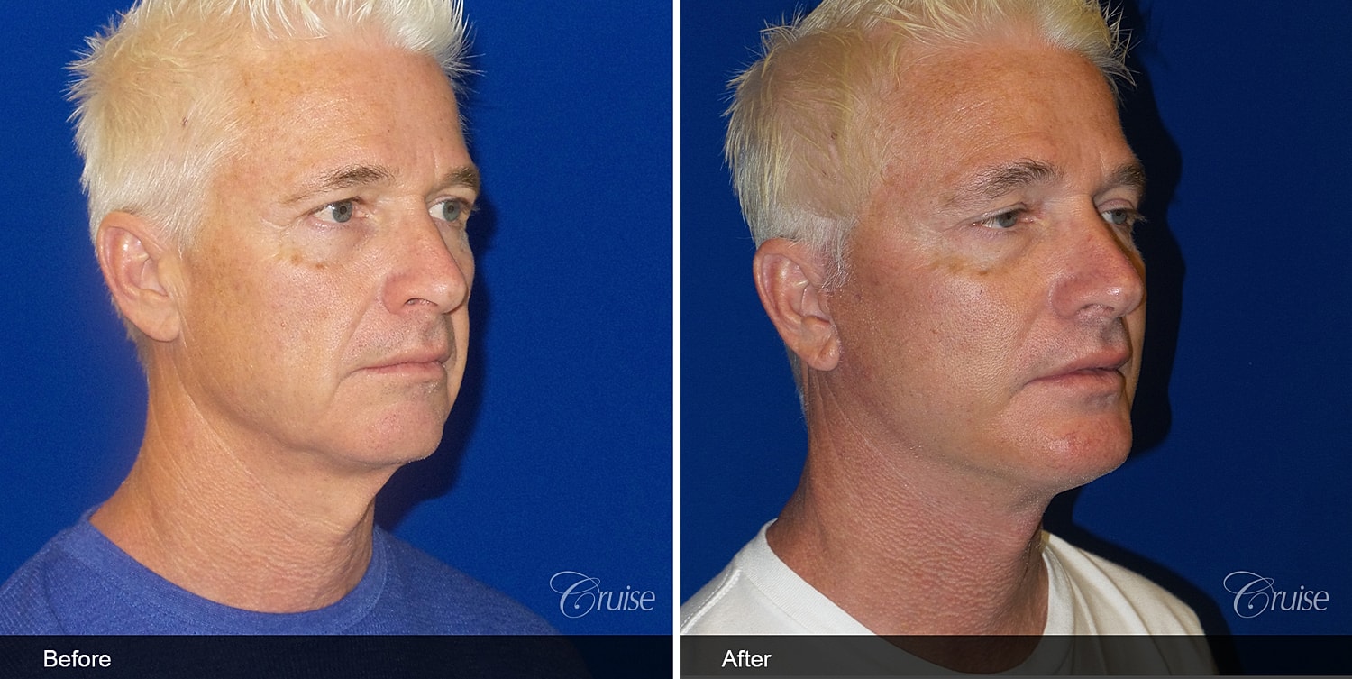 Neck Lift Before & After