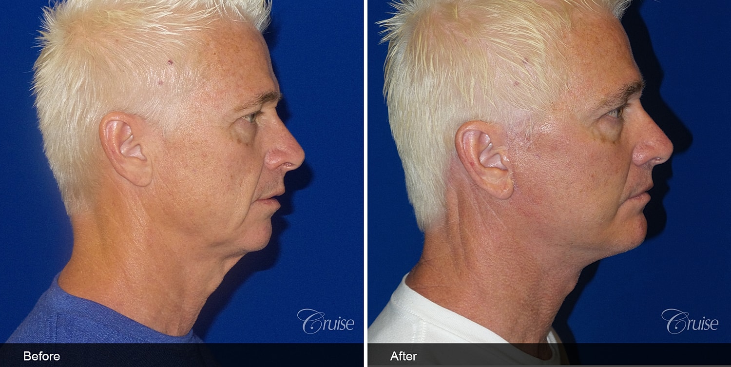 Neck Lift Before & After