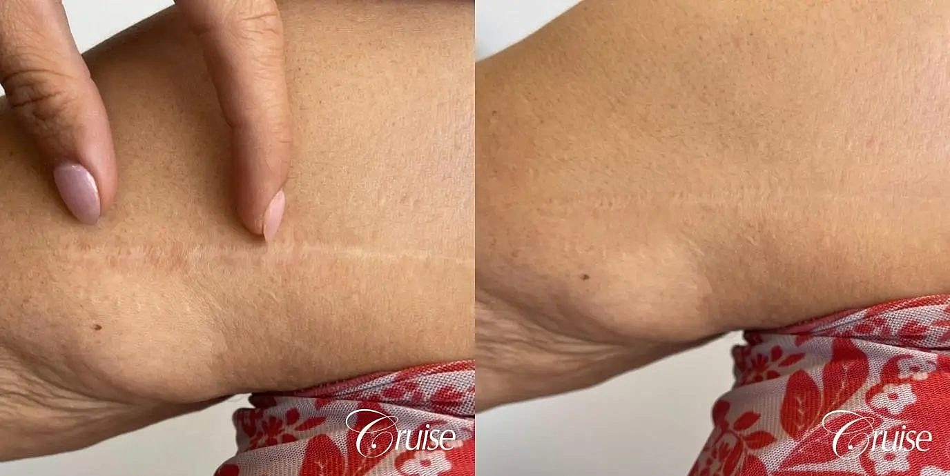 Medical Tattooing Before & After