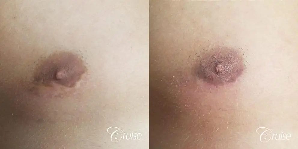 Medical Tattooing Before & After