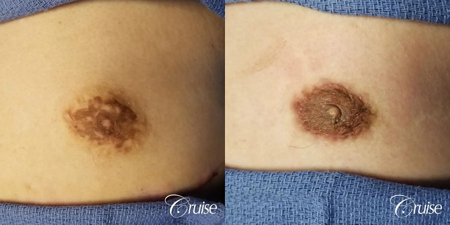 Medical Tattooing Before & After
