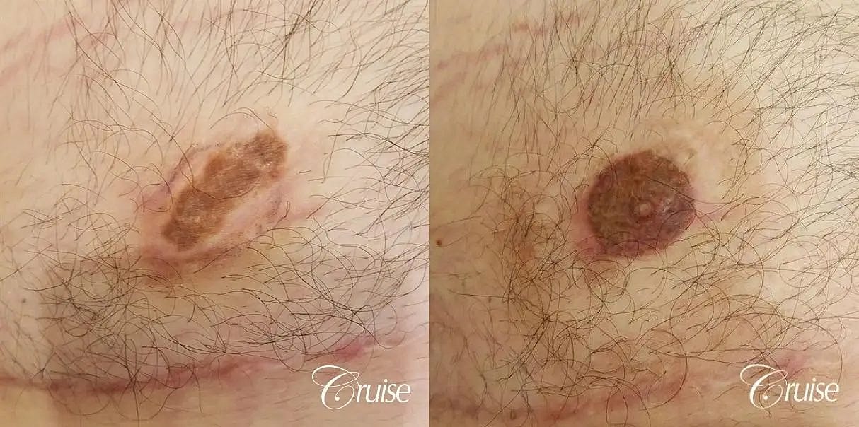 Medical Tattooing Before & After