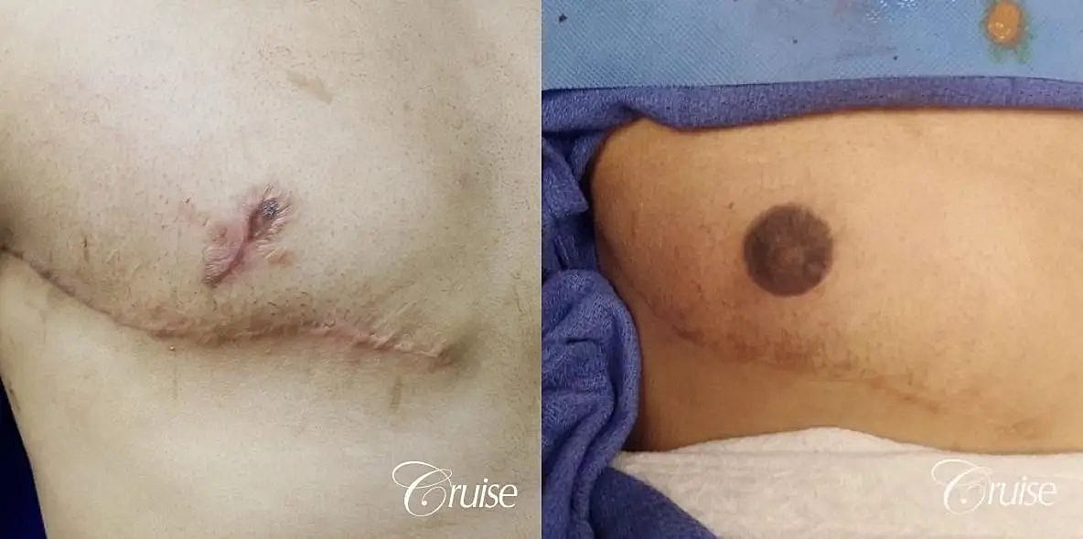 Medical Tattooing Before & After