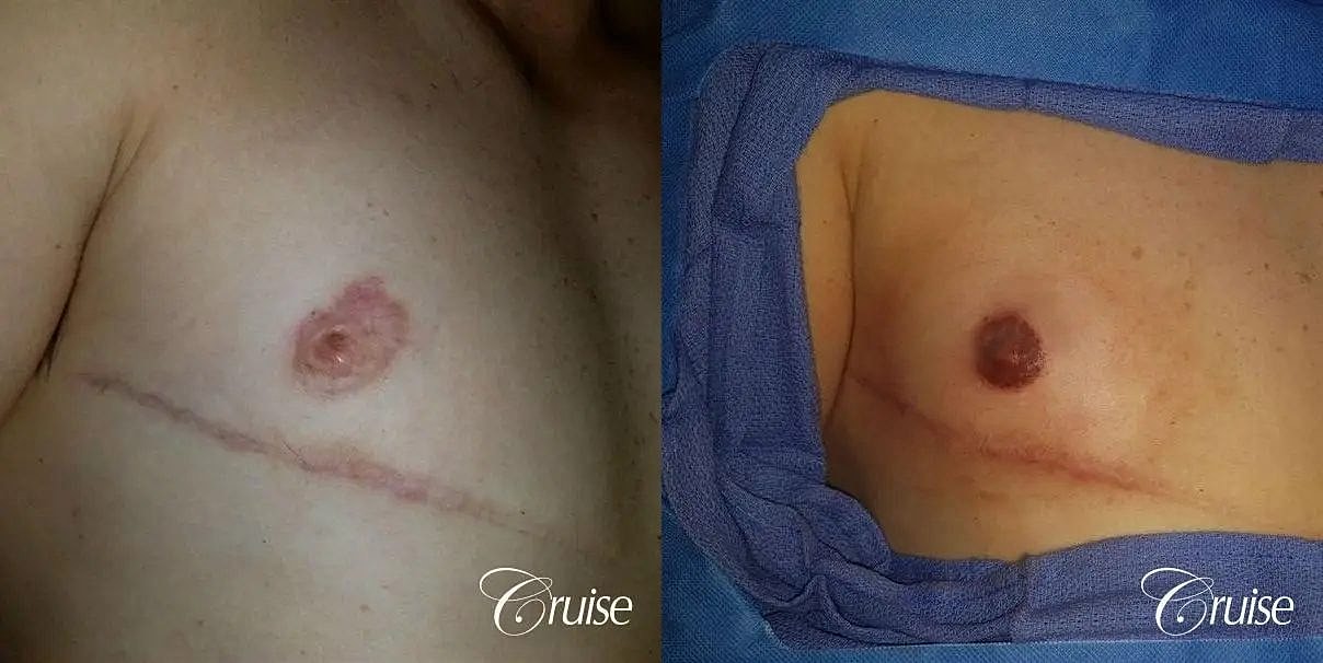 Medical Tattooing Before & After