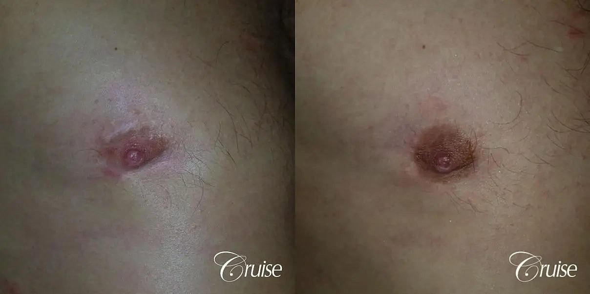 Medical Tattooing Before & After