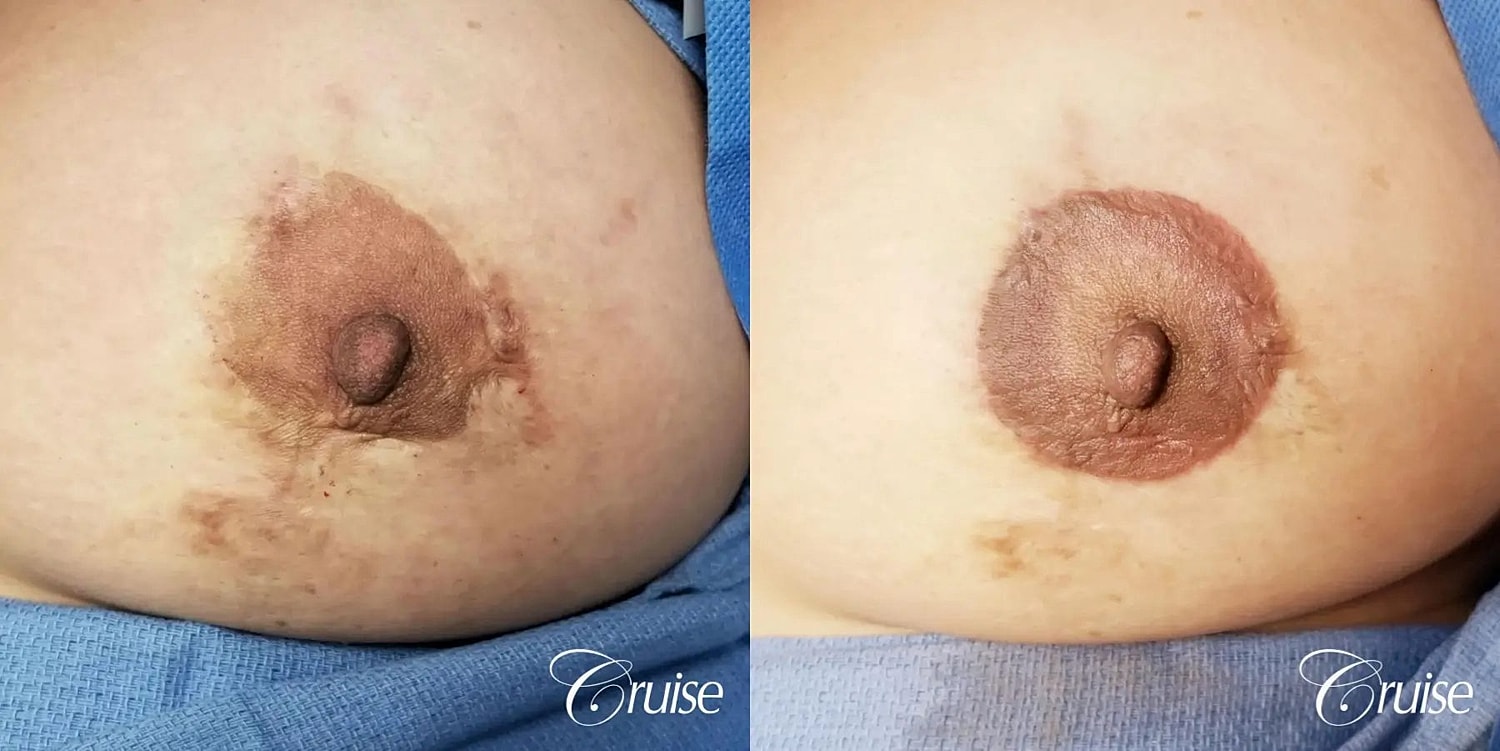 Medical Tattooing Before & After