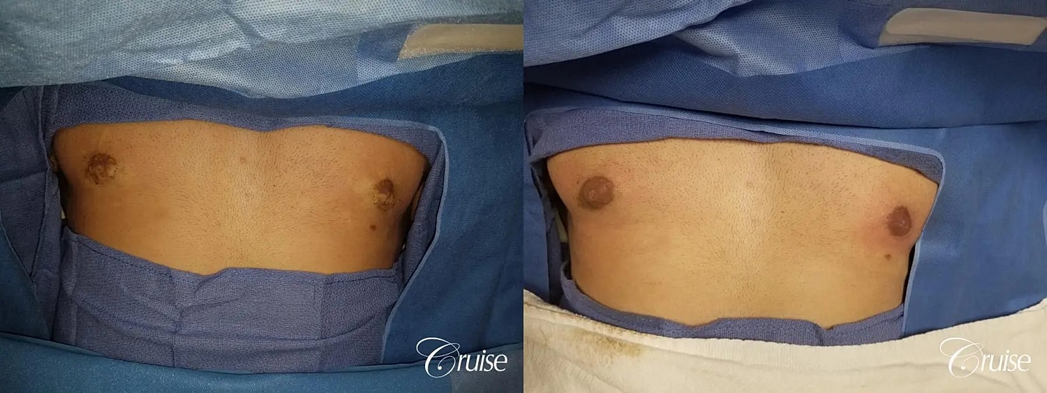 Medical Tattooing Before & After