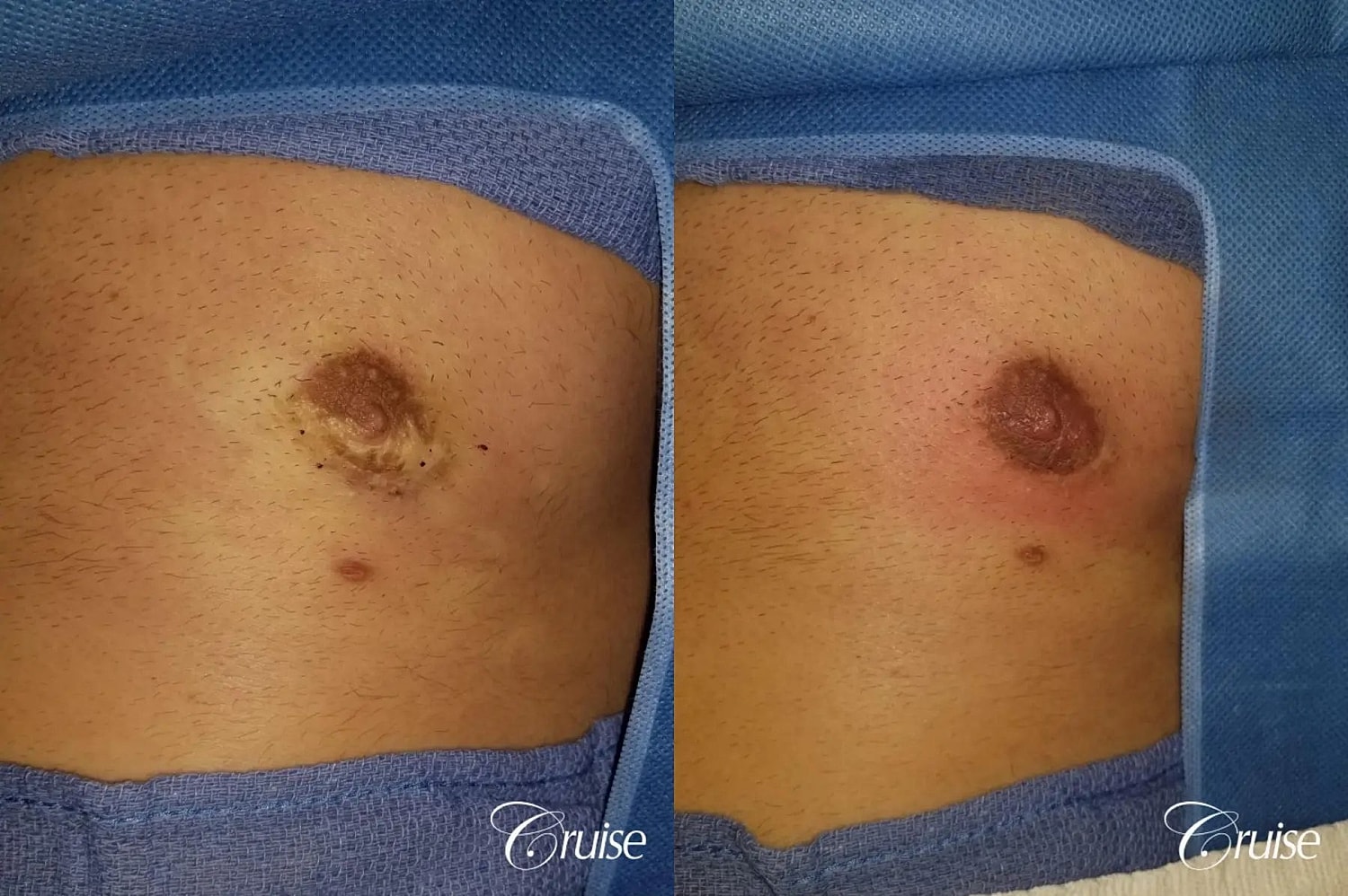 Medical Tattooing Before & After