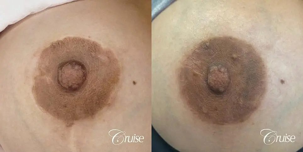 Medical Tattooing Before & After