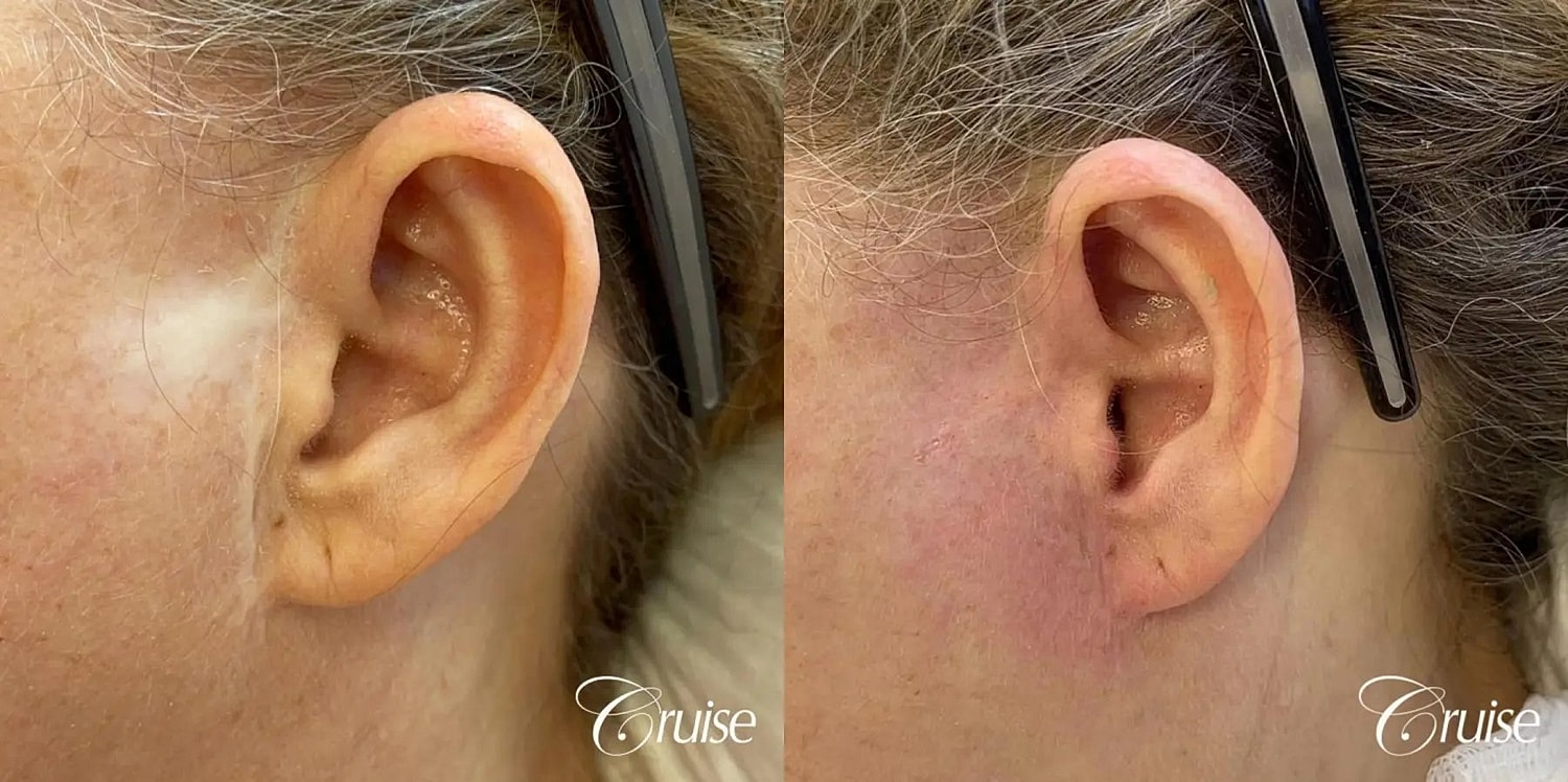 Medical Tattooing Before & After