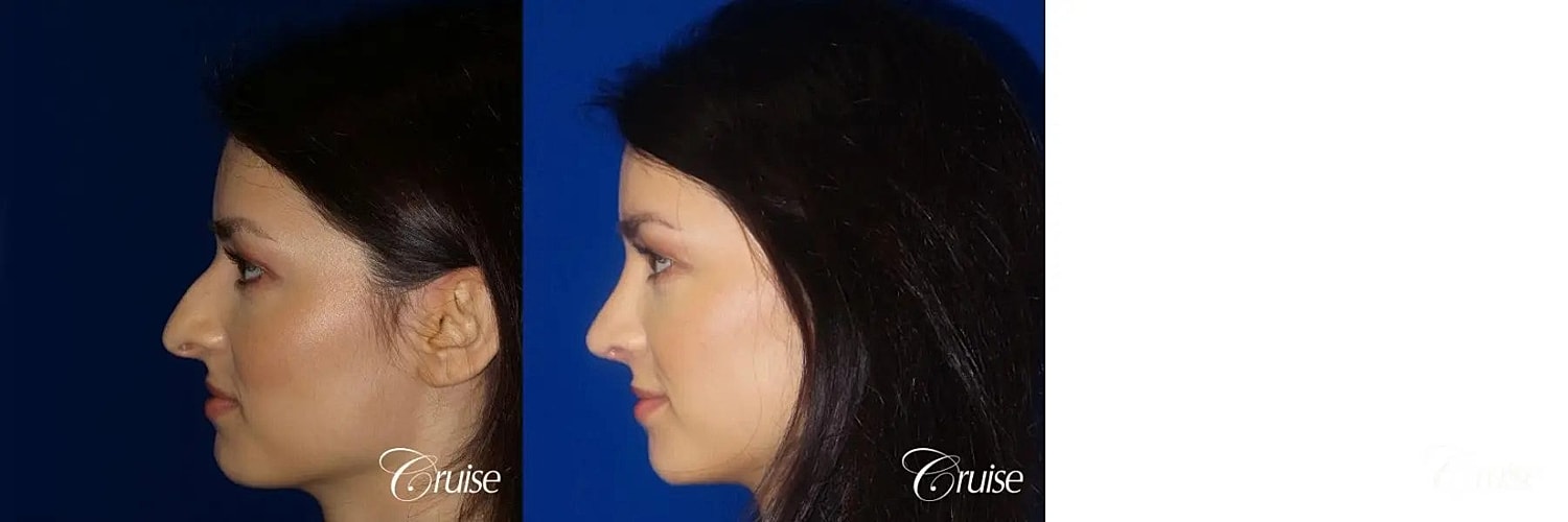 Rhinoplasty Before & After
