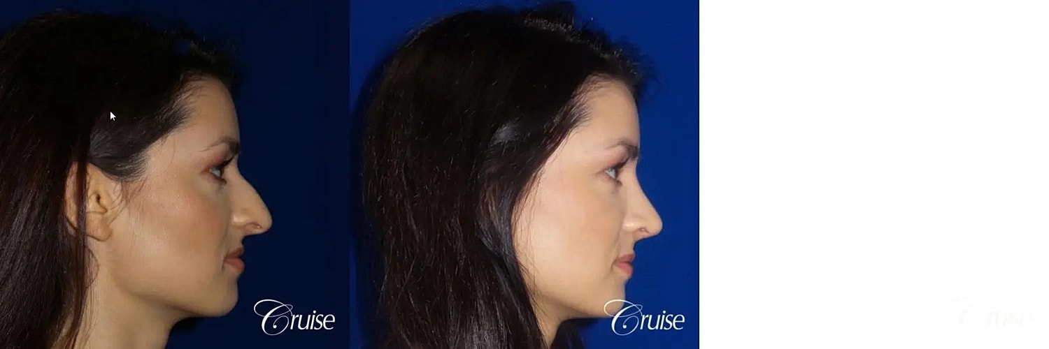 Rhinoplasty Before & After