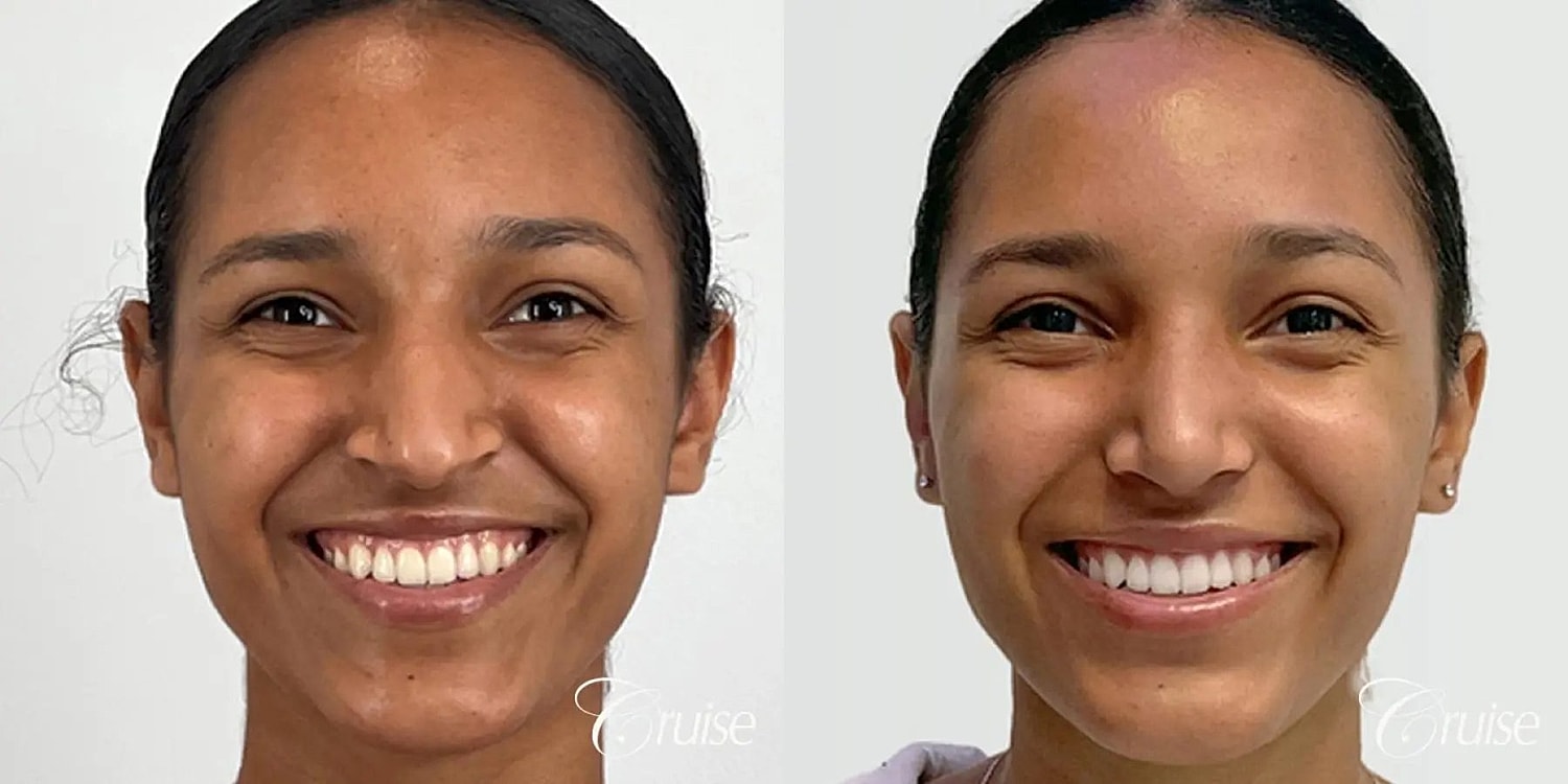 Rhinoplasty Before & After