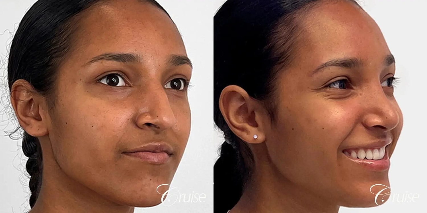 Rhinoplasty Before & After