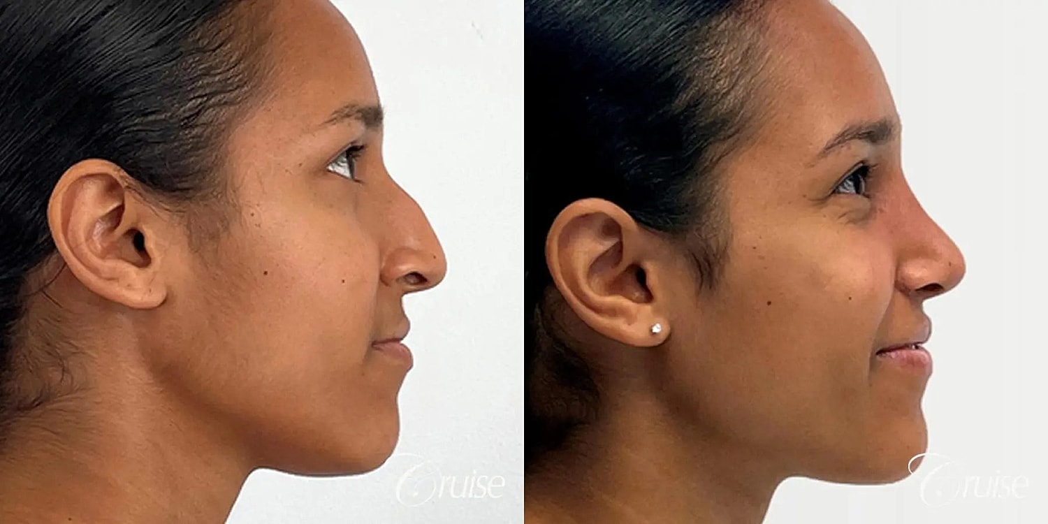 Rhinoplasty Before & After