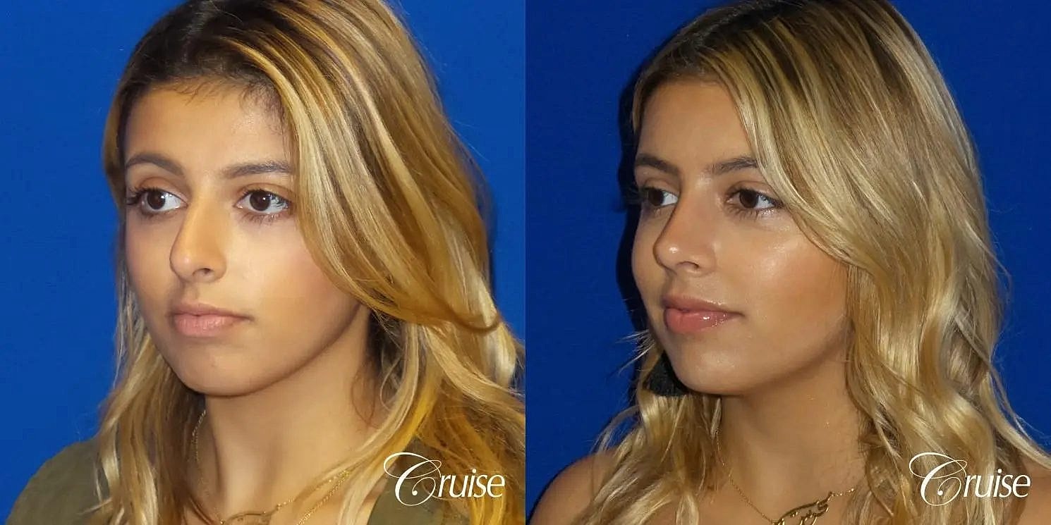 Rhinoplasty Before & After
