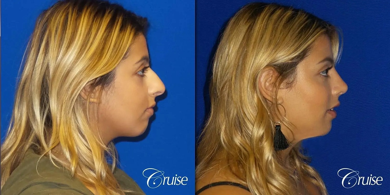Rhinoplasty Before & After