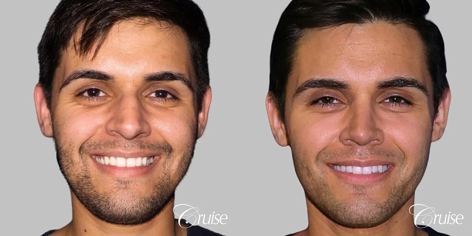 Rhinoplasty Before & After